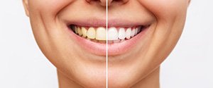 The amount of discoloration on your teeth may affect the cost of professional teeth whitening treatment