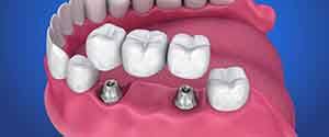 A 3D illustration of an implant bridge