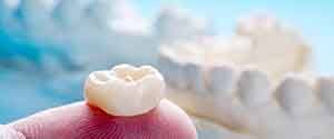 A closeup of a dental crown sitting on a person’s finger