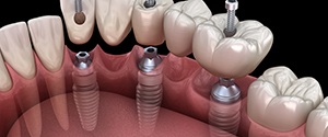 Illustration of implant bridge