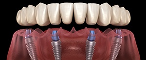 Illustration of implant denture