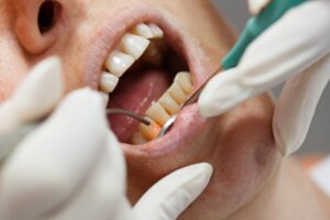 Close up of dental laser treating gum disease
